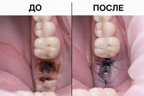 Работа доктора Саркиса Эдуарди Трдатяна в клинике Имплант Эксперт