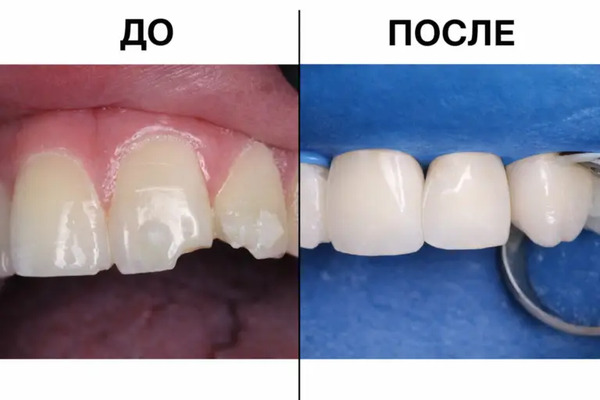 Результат лечения у доктора Урусовой Аси Юсуфовны в клинике Имплант Эксперт
