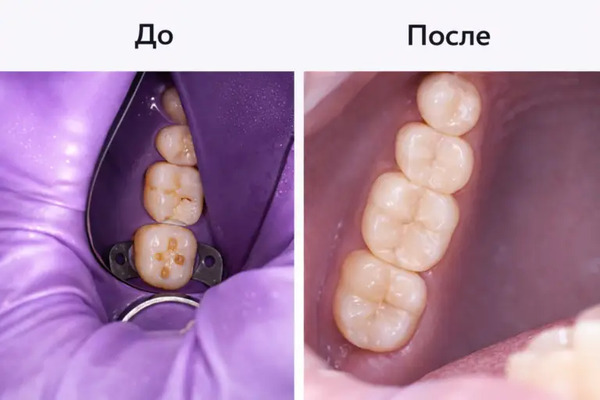 Снимки до и после лечения жевательных зубов в стоматологической клинике «Имплант Эксперт». Лечение выполнено врачом Шадией Джавидовной Намазовой.