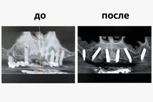 Сравнение КТ до и после имплантации зубов по технологии Все на шести (All-on-6). Лечение проведено доктором Саркисом Эдуарди Трдатяном в клинике "Имплант Эксперт".