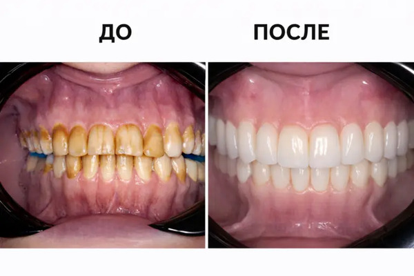 Результат коррекции тетрациклиновых зубов с помощью виниров. До и после — клиника «Имплант Эксперт», доктор Рахим Увайсович Джабраилов