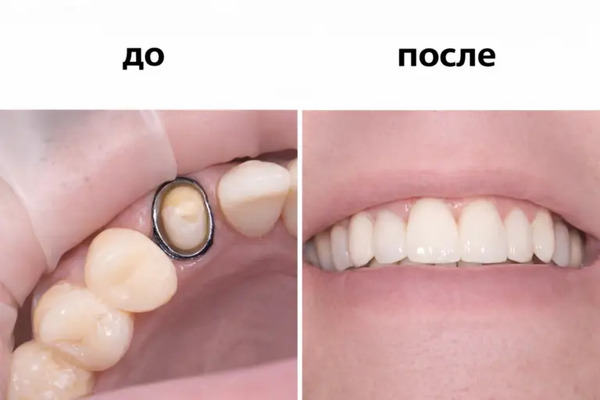 Снимки до и после протезирования зубов. Клиника «Имплант Эксперт», врач Адалаев Хочбар Ильясович