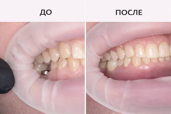 Фото до и после протезирования зубов на имплантах. Лечение выполнено в клинике «Имплант Эксперт» врачом-имплантологом Адалаевым Хочбаром Ильясовичем.