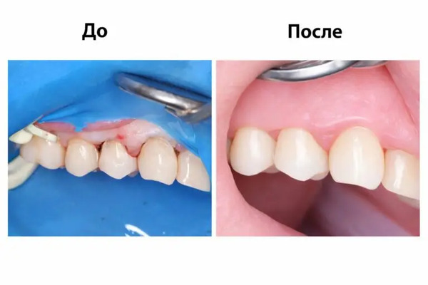 До и после лечения зубов, выполненного доктором Урусовой Асей Юсуфовной в клинике Имплант Эксперт