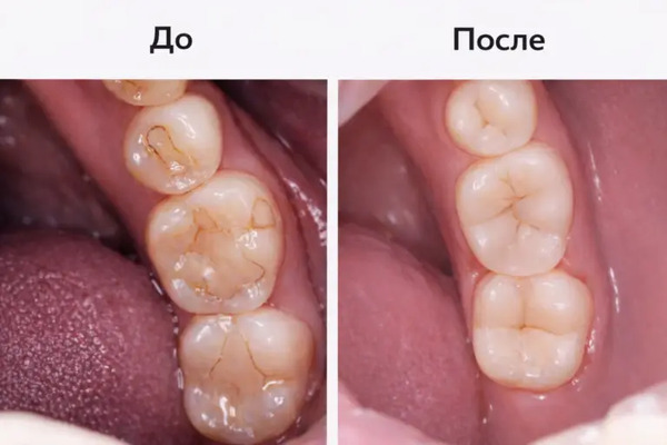 Результат лечения жевательных зубов: состояние до и после стоматологического лечения в клинике «Имплант Эксперт». Врач — Шадия Джавидовна Намазова.