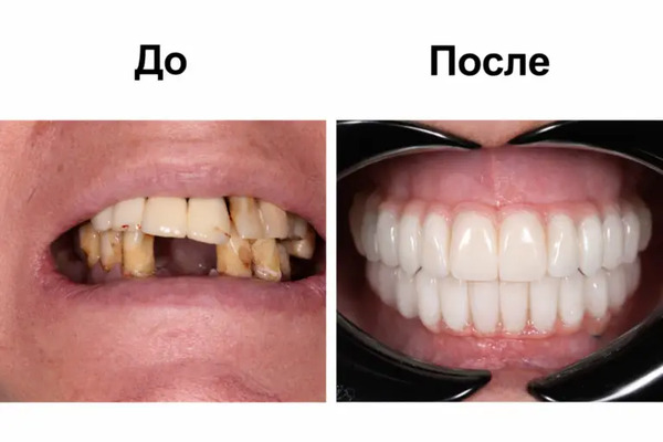 Результат протезирования зубов по методике All-on-4: состояние до лечения и после установки несъёмного протеза. Работа врача Рахима Увайсовича Джабраилова, клиника «Имплант Эксперт».