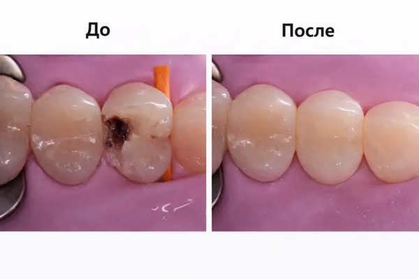 Работа доктора Яшенковой Анны — восстановление зубов на с безупречным эстетическим результатом