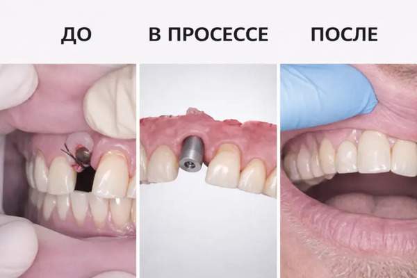 Сравнение: до, в процессе и после одномоментной имплантации зуба с немедленной нагрузкой. Работа доктора Адалаева Хочбара Ильясовича — клиника «Имплант Эксперт»