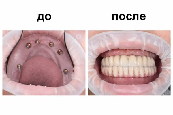 Результат протезирования зубов по методике All-on-5 в клинике «Имплант Эксперт». Пациент до и после установки несъёмного протеза. Врач: доктор Адалаев Хочбар Ильясович.