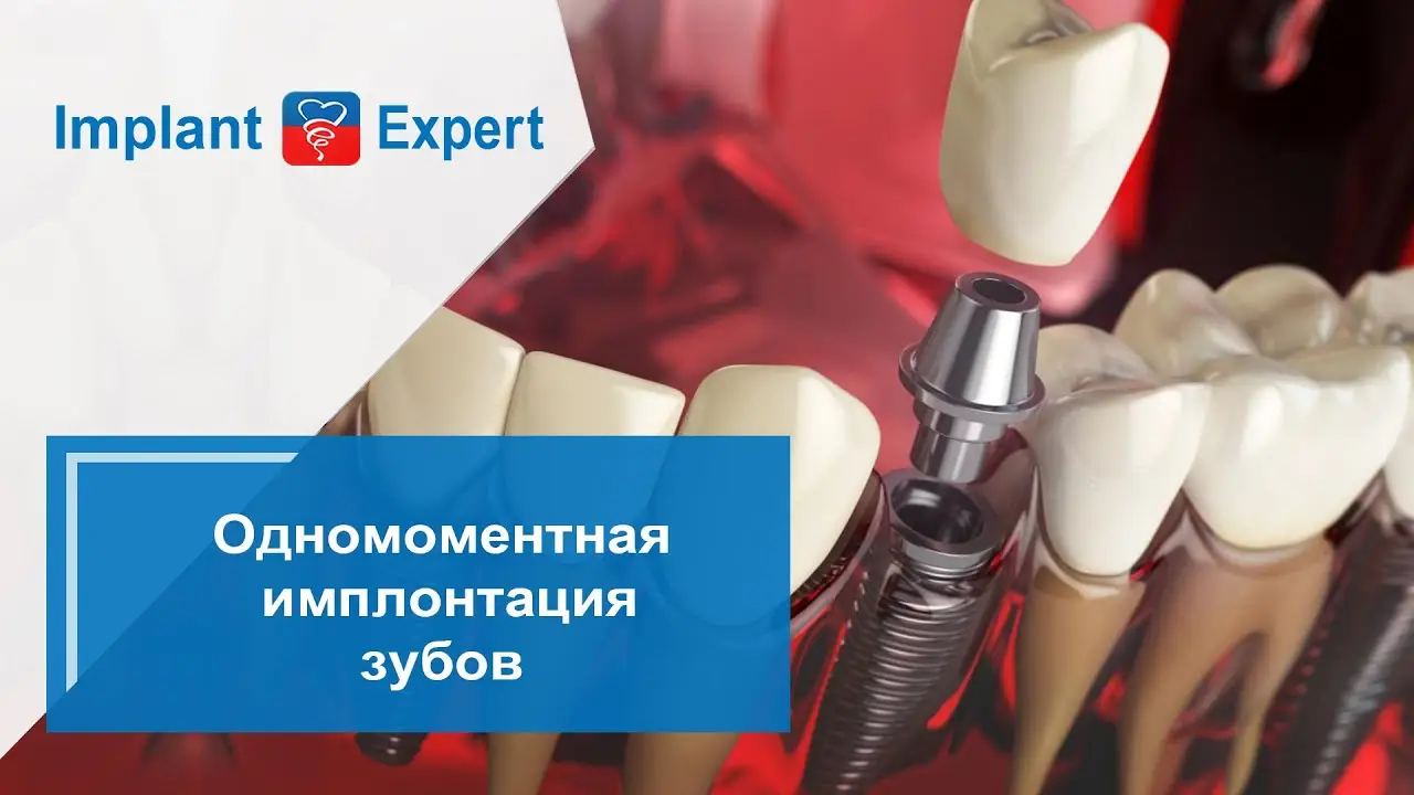 Одномоментная имплантация
