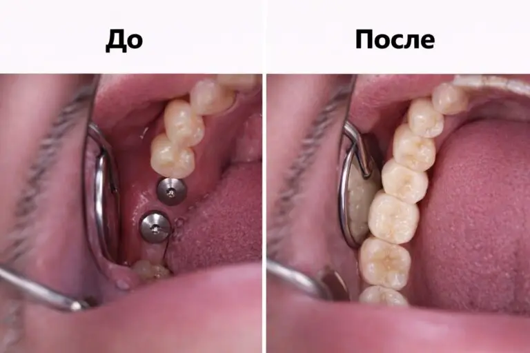 Имплантация зубов в стоматологической клинике Имплант Эксперт