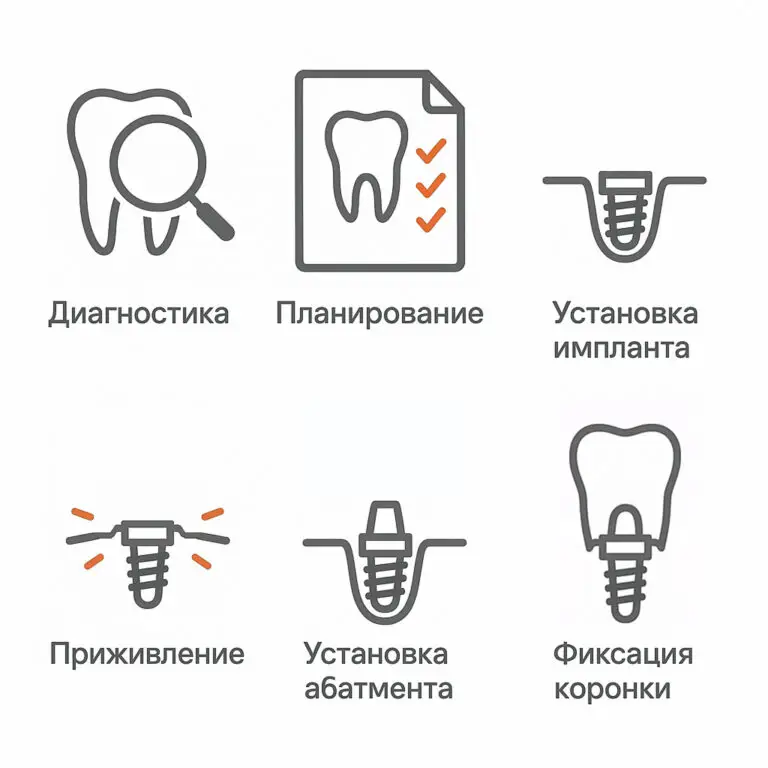 Этапы установки зубного импланта