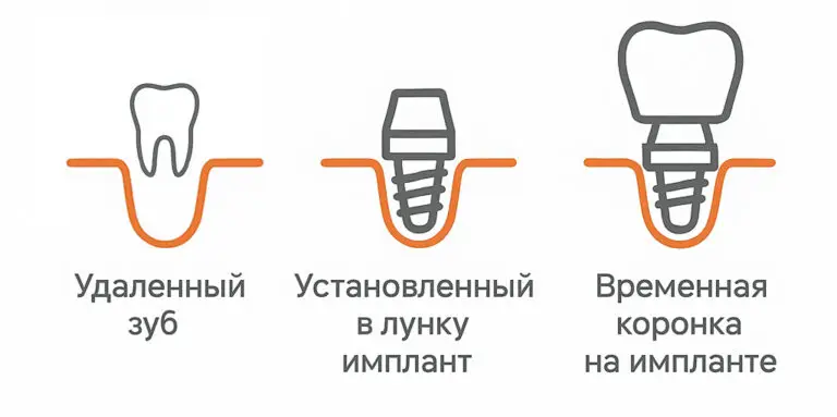 Одномоментная установка имплантата