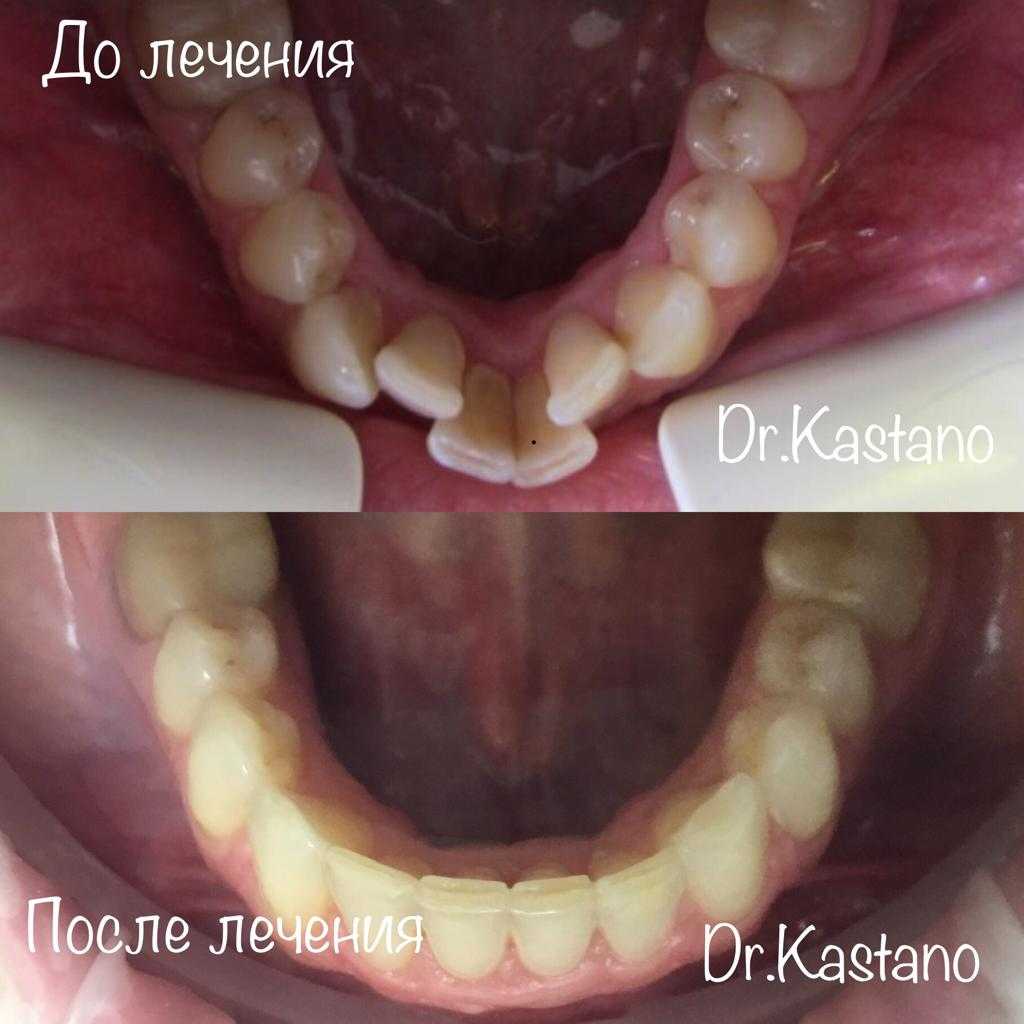 Исправление скученности на элайнерах