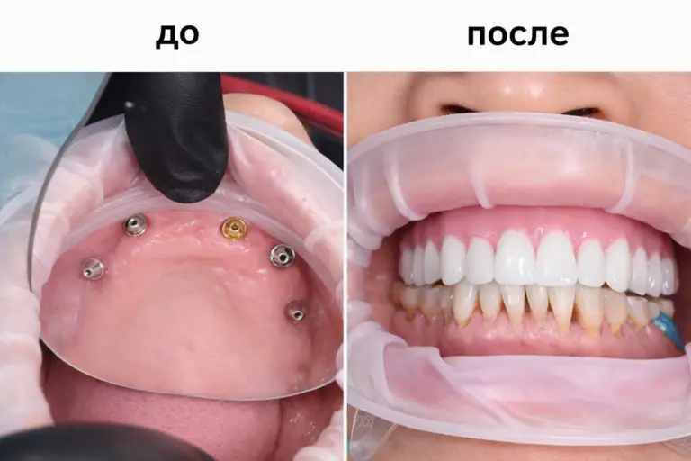 Протезирование зубов на имплантах "всё на пяти" до и после — Имплант Эксперт, доктор Адалаев Хочбар Ильясович