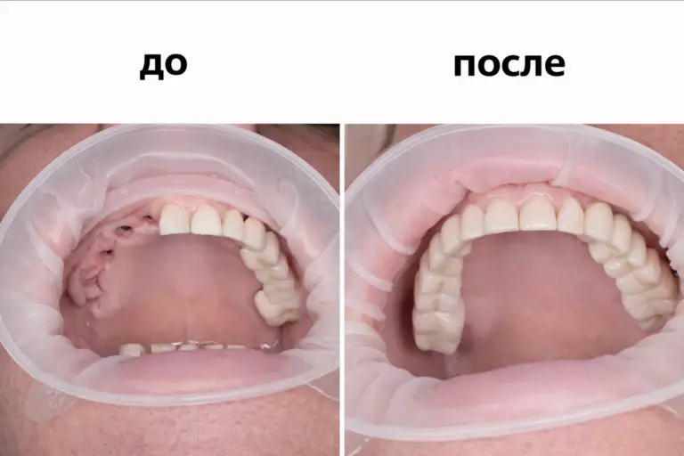 Протезирование зубов на имплантах — фото до и после лечения в клинике «Имплант Эксперт», врач Адалаев Хочбар Ильясович