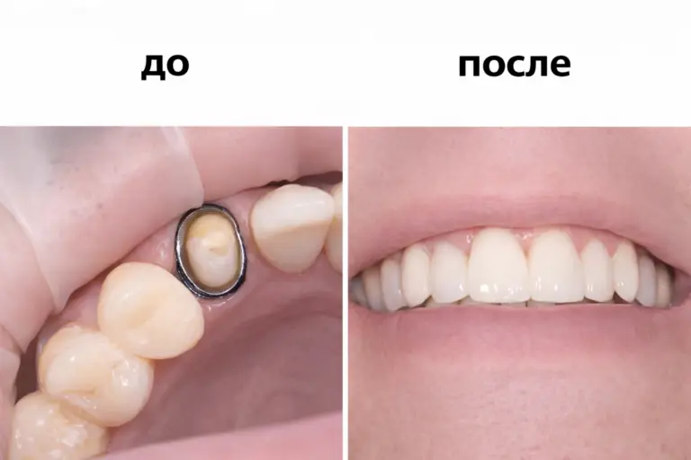 Протезирование зубов — фото до и после лечения в клинике «Имплант Эксперт», врач Адалаев Хочбар Ильясович