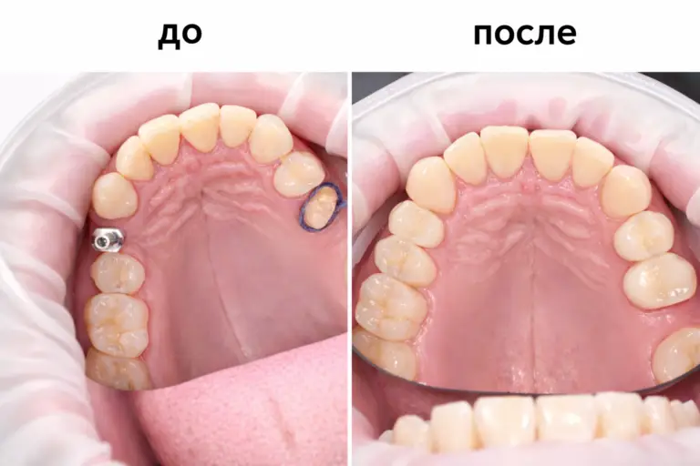 Протезирование зубов до и после — стоматологическая клиника Имплант Эксперт, доктор Адалаев Хочбар Ильясович