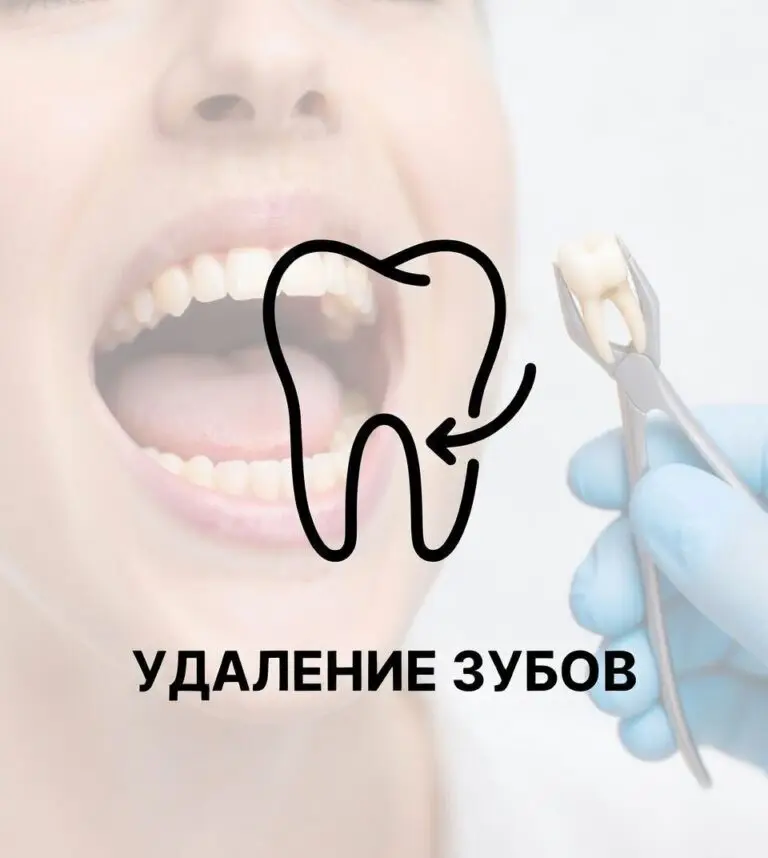 Удаление зубов