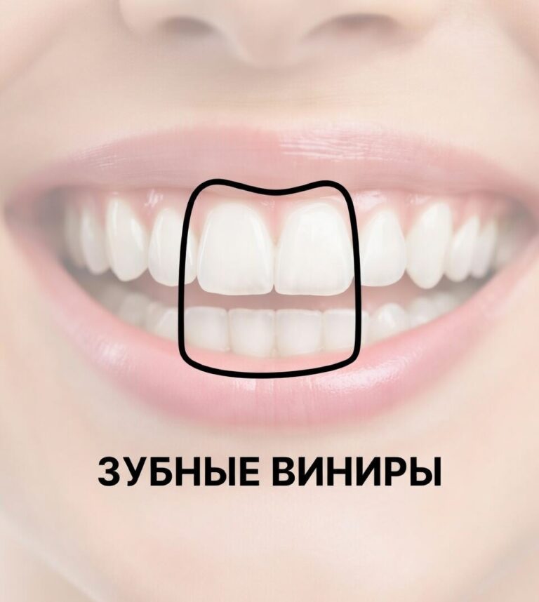 Зубные виниры