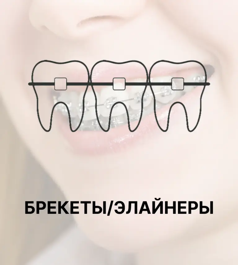 Брекеты/элайнеры