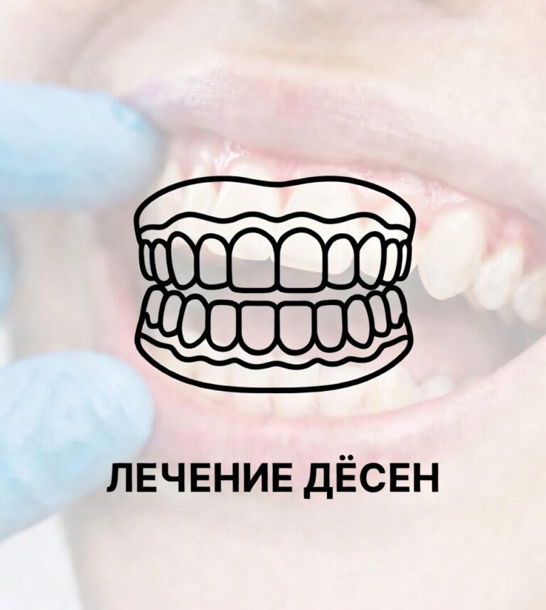 Лечение дёсен