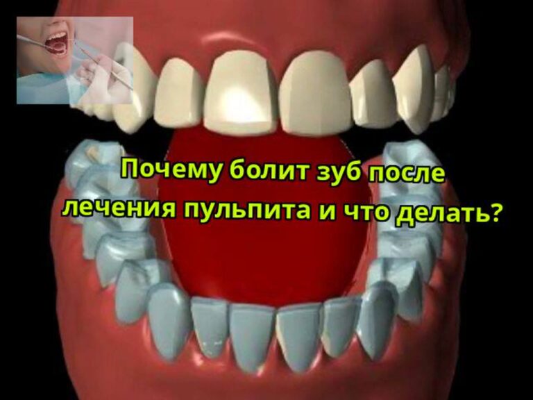 Почему болит зуб после лечения пульпита — видео