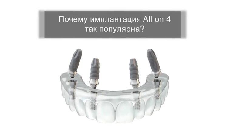 Почему All-on-4 так популярна — видео