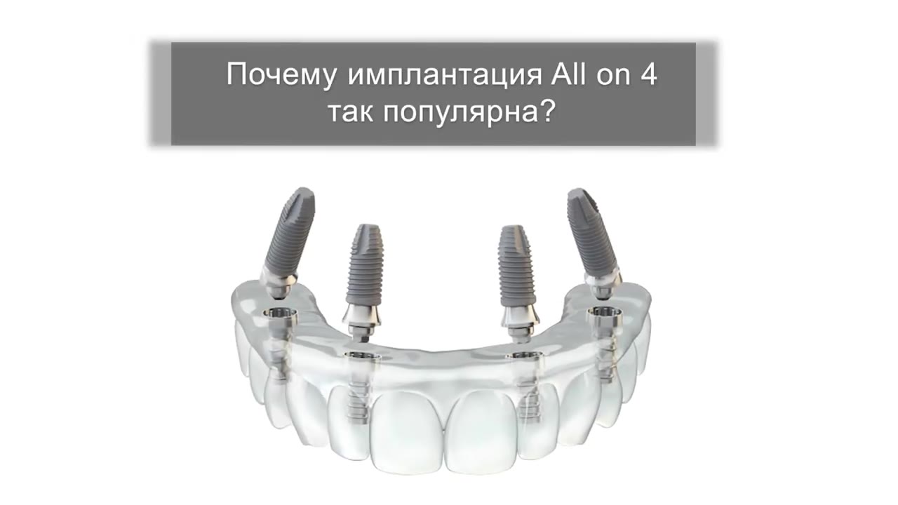 Почему All-on-4 так популярна — видео