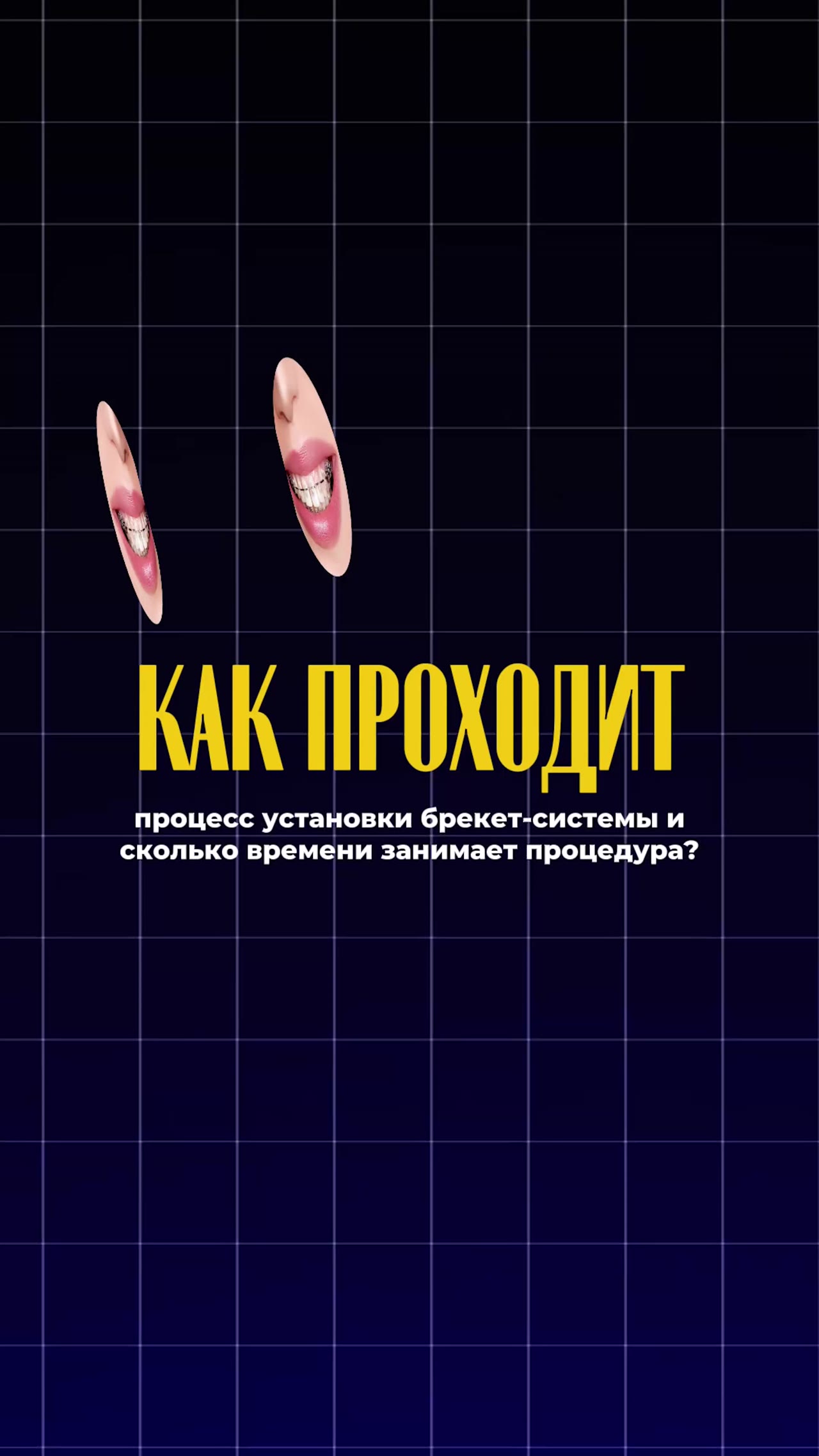 Как проходит установка брекетов — видео